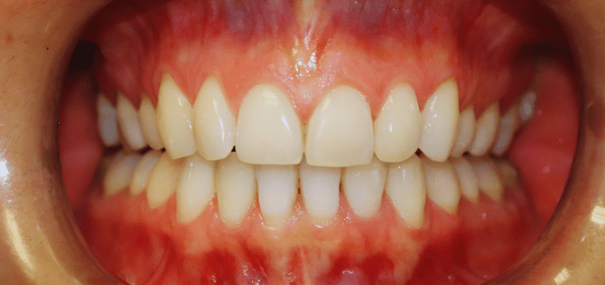 After - Merrowpark  Dental