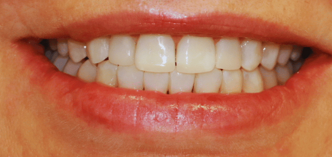 After - Merrowpark  Dental