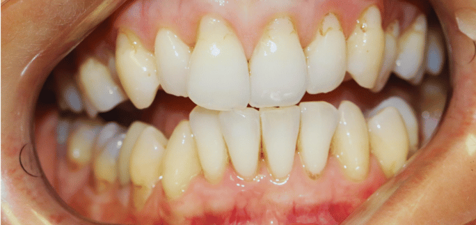 Before - Merrow Park Dental