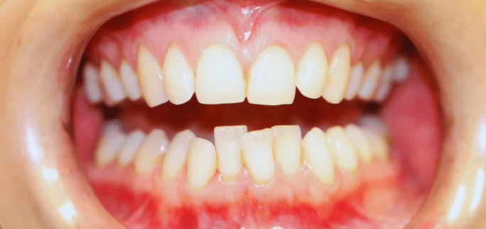 Before - Merrow Park Dental