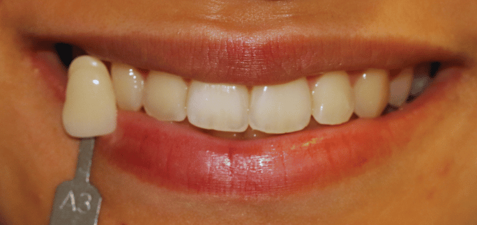 Before - Merrow Park Dental