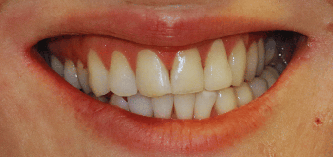 After - Merrowpark  Dental