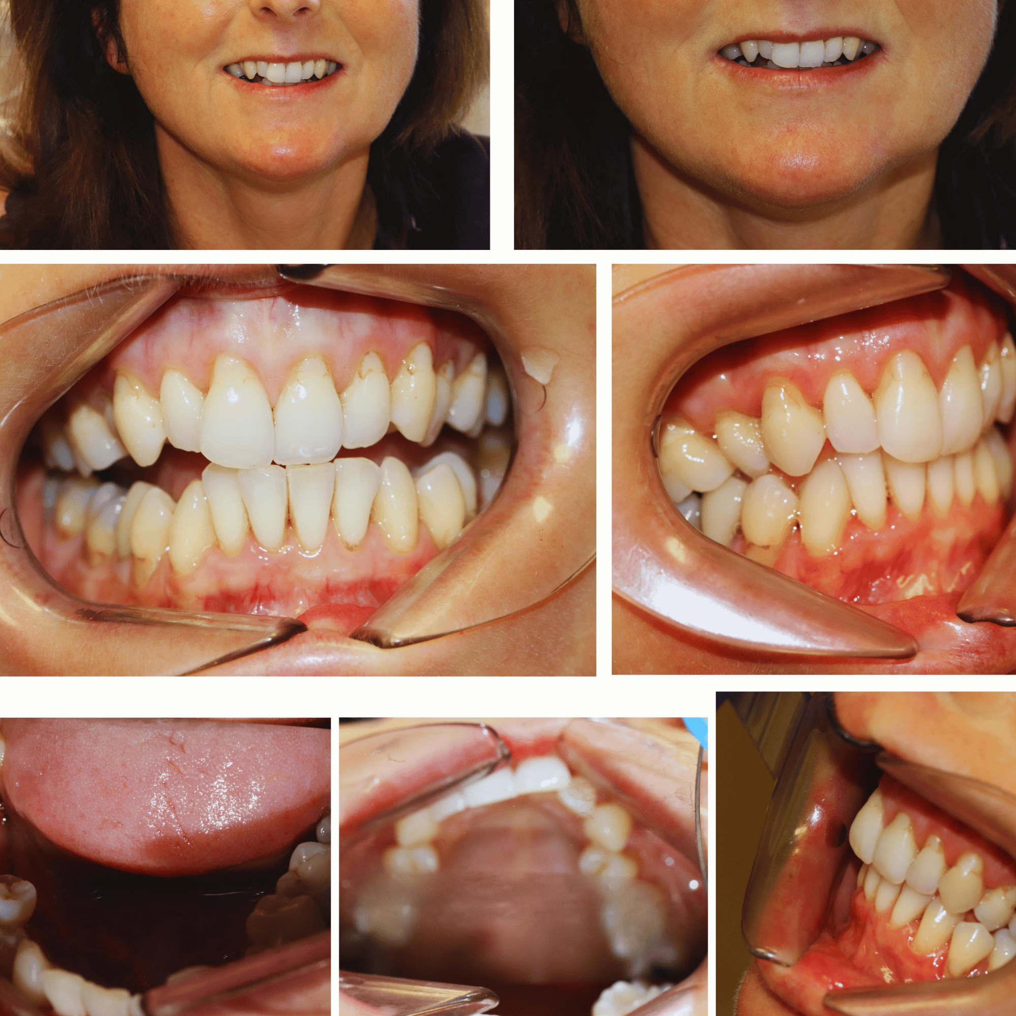 Case 1 - Implants & Invisalign - Merrow Park Dental | Dentist in ...